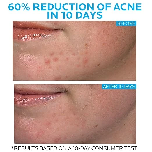 La Roche-Posay Effaclar Duo Dual Action Acne Spot Treatment Cream with Benzoyl Peroxide Acne Treatment 理膚寶水 抗痘保養品